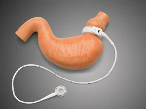 Gastric Band Success