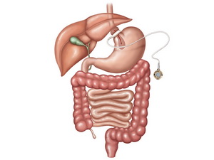 Gastric Band