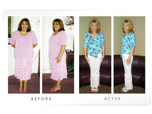 Gastric Band Before and After