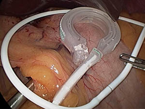 Gastric Band in the UK