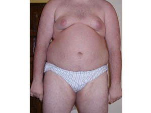 Gastric Band Side Effects