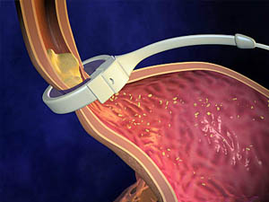 Gastric Band Stories