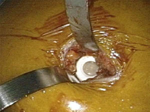 Laparoscopic Gastric Band