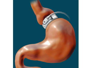 Types of Gastric Band Types of Gastric Band